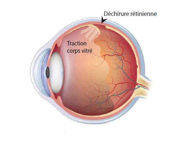 Decollement De Retine Institut Ophtalmologique Sourdille Atlantique