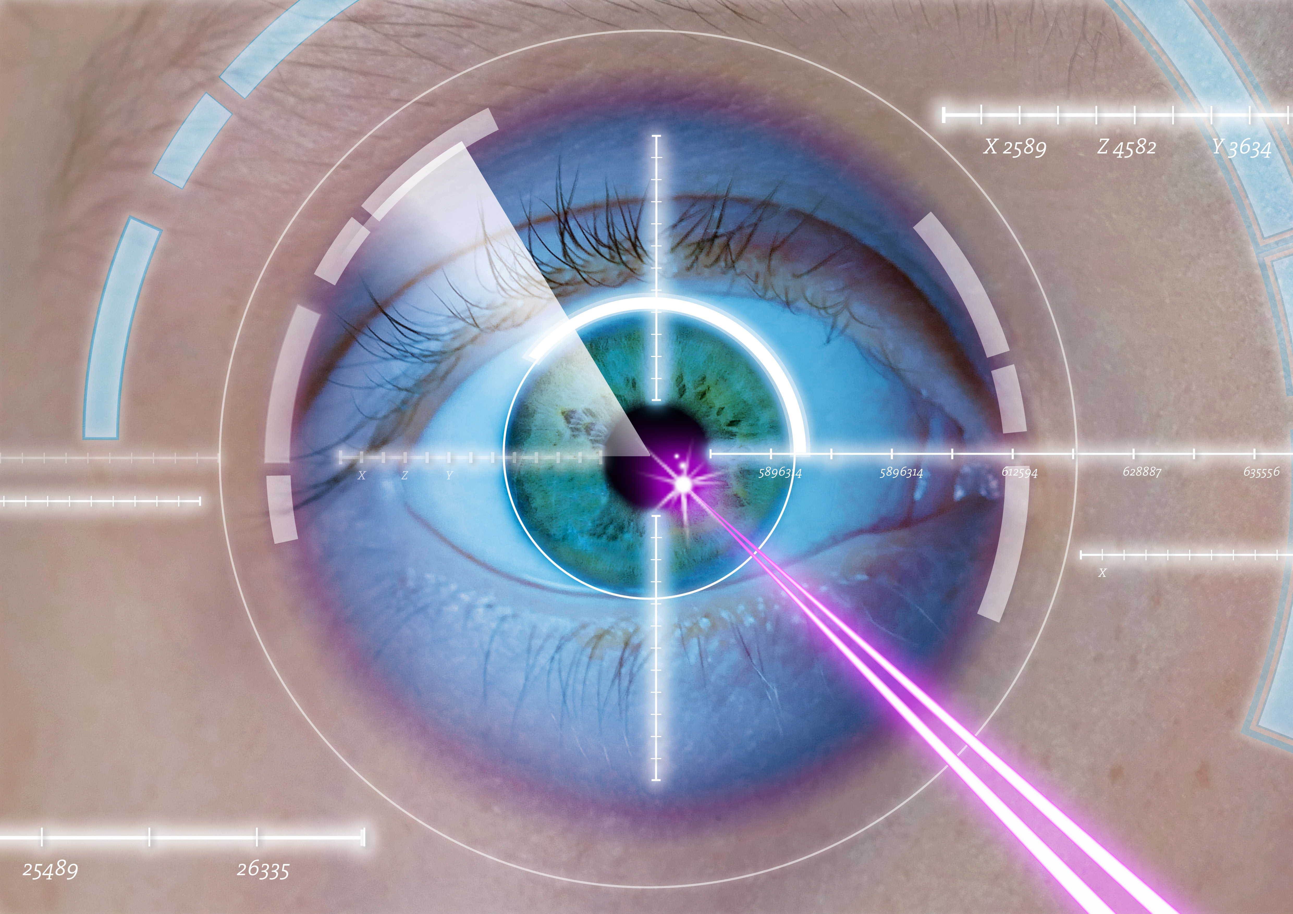 Операция на глаза восстановление зрения. Лепто ласик. Эксимер-лазерная коррекция астигматизма. Лазерная коррекция аномалий рефракции.