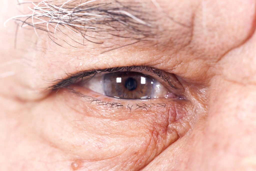 Glaucome Et Hypertension Oculaire Institut Ophtalmologique Sourdille Atlantique Glaucome Et Hypertension Oculaire Institut Ophtalmologique Sourdille Atlantique